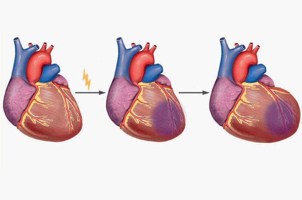 Миокарддын инфаркты плечолордун оорушуна алып келет