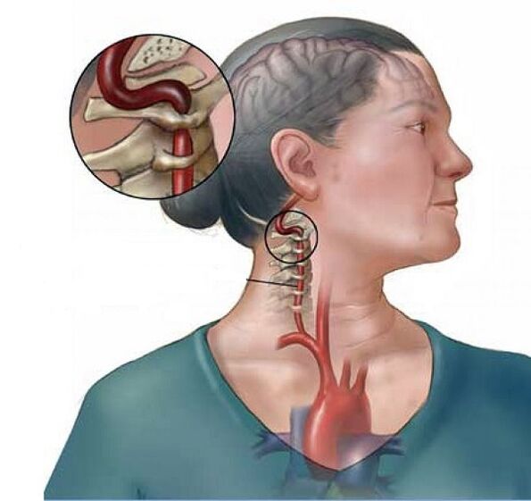 омурткалуу артерия синдрому моюнчанын моюнчасынын моюнчасынын синдрому