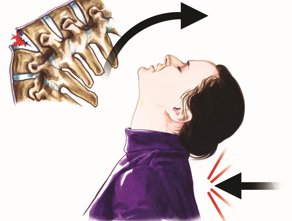 моюн оорусунун себеби катары омуртка зыян